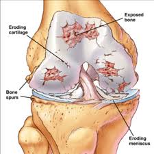 arthrosis, osteoarthritis, ساییدگی , دکتر حسین ارجمند متخصص طب فیزیکی و نوانبخشی