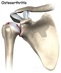 دکتر حسین ارجمند, ساییدگی مفصل شانه, shoulder arthrosis