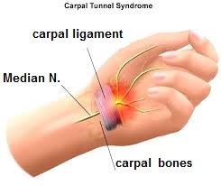 دکتر حسین ارجمند, خواب رفتگی دست, دست درد, CTS ,carpal tunnel syndrome