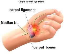 دکتر حسین ارجمند, خواب رفتگی دست, دست درد, CTS ,carpal tunnel syndrome دکتر حسین ارجمند, خواب رفتگی دست, دست درد, CTS ,carpal tunnel syndrome