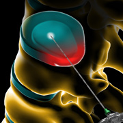 درمان دیسک کمر بوسیله اوزون (ozone nucleolysis) برای اولین بار در شیراز