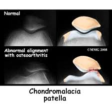 دکتر حسین ارجمند, شیراز, نرمی کشکک,chondromalacia, patellofemoral pain syndrome