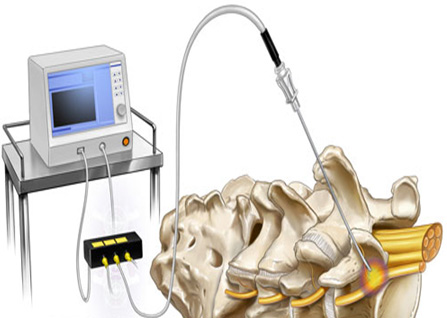 رادیوفرکوئنسی (Radiofrequency neurotomy)