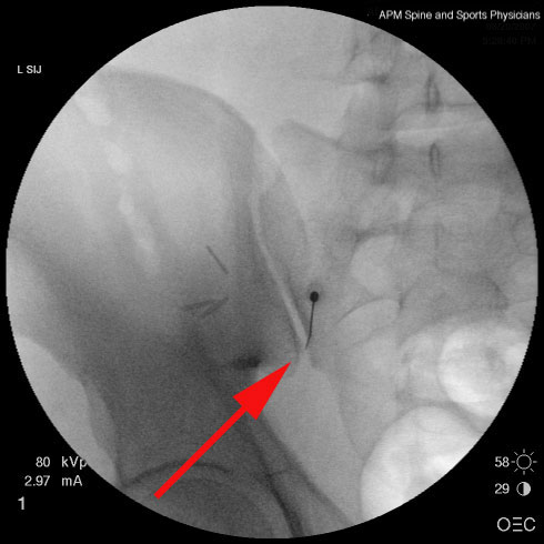 دکتر حسین ارجمند, مفصل ساکروایلیاک , کمر درد, شیراز, متخصص طب فیزیکی و توانبخشی,sacroiliac joint dysfunction