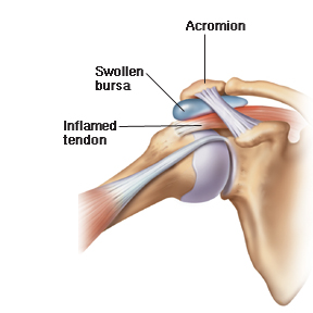 بورسیت, bursitis, دکتر حسین ارجمند, شیراز