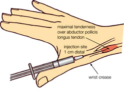 دکتر حسین ارجمند, شیراز, التهاب تاندون, tendonitis,De Quervain