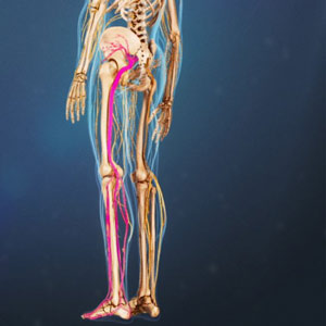 درد سیاتیک (Sciatica)