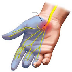 گیرافتادگی عصب مدیان در مچ (carpal tunnel syndrome)