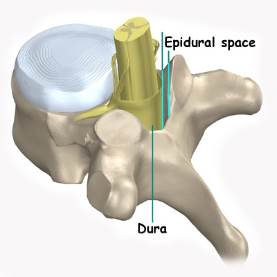 تزریق اپیدورال (epidural injection)
