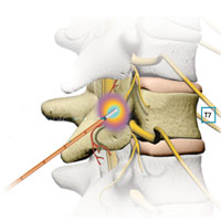 رادیوفرکوئنسی (Radiofrequency neurotomy)