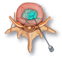 تزریق اوزون در داخل دیسک (ozone nucleolysis)