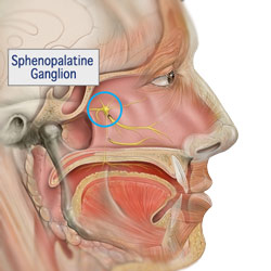  بلاک گانگلیون اسفنوپالاتین (sphenopalatine ganglion block)