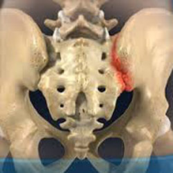 التهاب مفصل ساکروایلیاک (sacroiliac joint dysfunction)