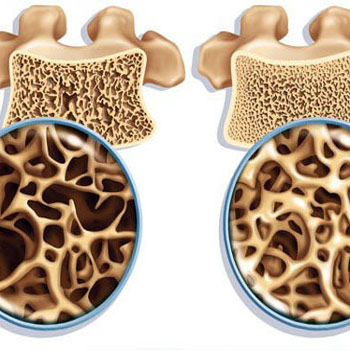 پوکی استخوان