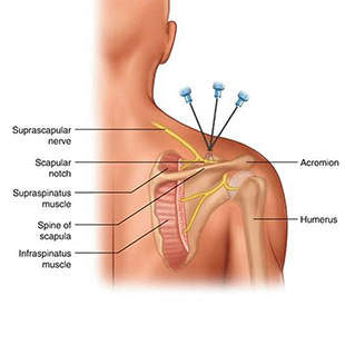 بلاک عصب سوپرااسکاپولار (suprascapular nerve block)