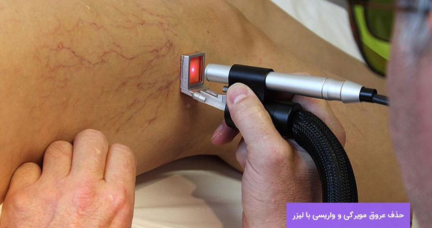 لیزر رگهای واریسی